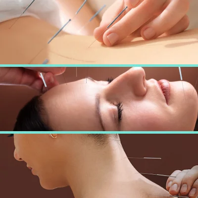 ACUPUNCTUERE-BENIFITS-1